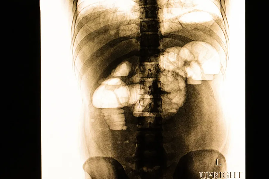 Ειλεόσ: Νοσοκομείο ΓΝΑ ¨Ο ΕΥΑΓΓΕΛΙΣΜΟΣ¨: Ειλεός και η κατάσταση της Μαρέβας Γκραμπόφσκι – Μητσοτάκη